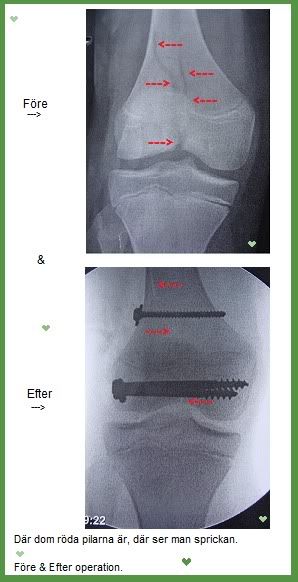 Röntgenbilderna på min spricka - före & efter operationen  © Hannah Larsson